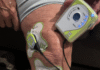 ZetrOZ Systems’ sam(R) Wearable Ultrasound Helps Osteoarthritis Patients Return to Regular Activities
