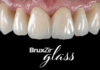 Glidewell Launches BruxZir(R) Glass Restorations