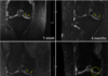 Regentis’ GelrinC Demonstrates Breakthrough in Regenerating Native-Like Cartilage Structure in Knee Repair on MRI Results Confirmed Using a Validated, Regulator-Accepted Method