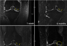 Regentis’ GelrinC Demonstrates Breakthrough in Regenerating Native-Like Cartilage Structure in Knee Repair on MRI Results Confirmed Using a Validated, Regulator-Accepted Method