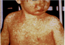 Measles Rare Pediatric Disease Drug Designation Application Filed for NV-387, PRV Provides for Strong Business Case, Says NanoViricides